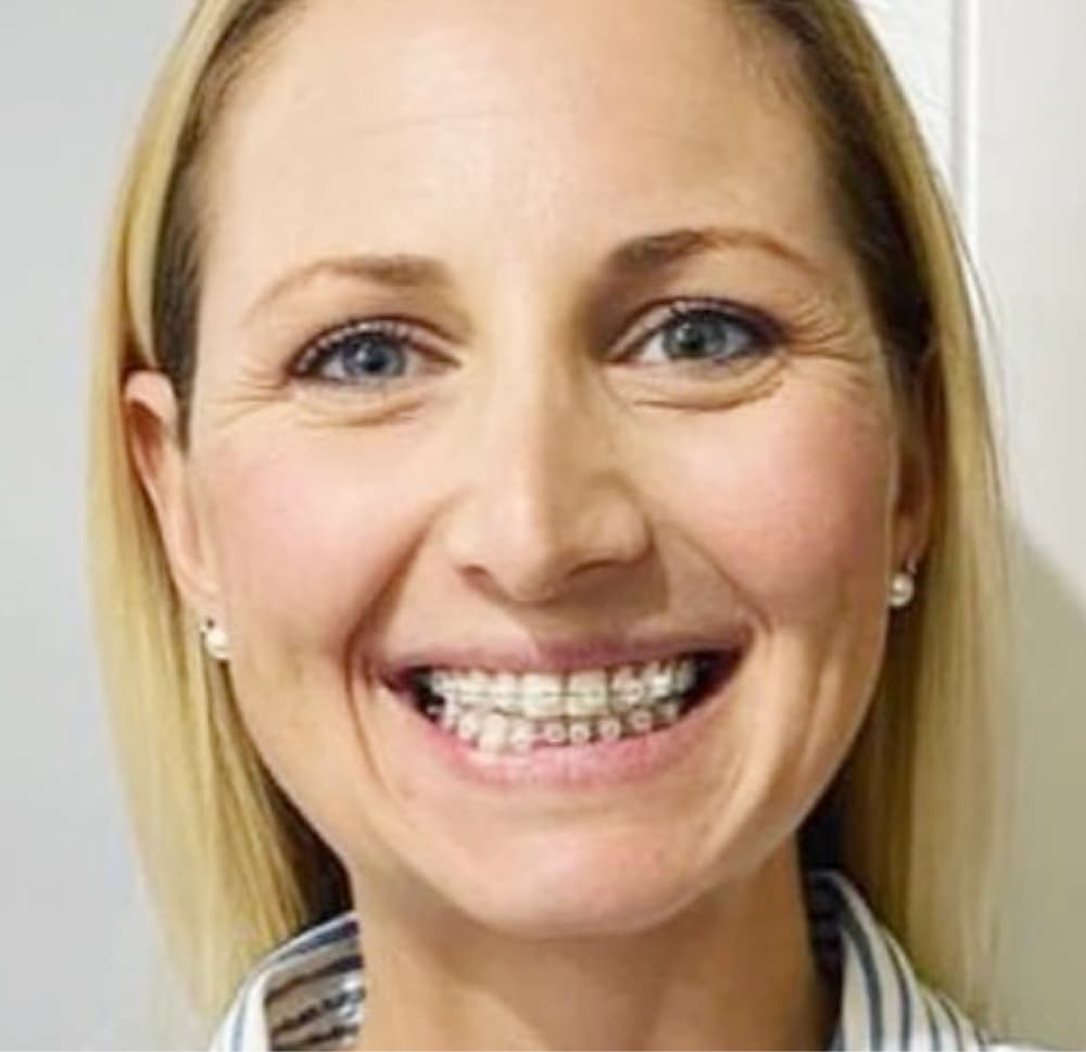 woman wearing clear ceramic braces